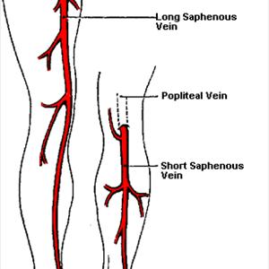 Varicose Vein Reduction - Psychological Impacts Of Spider Veins