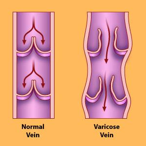 Varicose Veins Problems - Treatment For Varicose Veins