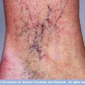 Varicose Veins Operation - The Treatment Of Varicose Veins