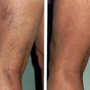 Varicose Ulcer Treatment - 8 Ways To Treat Varicose Veins With Non-Medical Methods