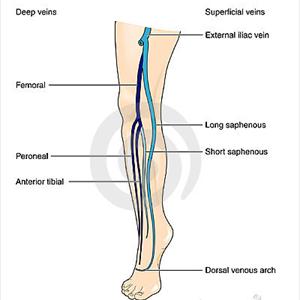 Varicose Veins Photos - Varicose Vein Removal, The Twisted Problem