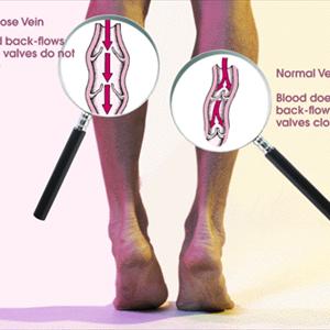 Ablation Varicose Veins - Detailed Information On Varicose Veins