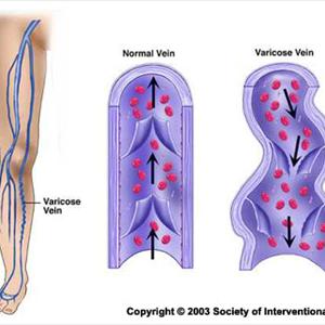 Varicosity | definition of varicosity by Medical dictionary