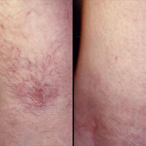 Weeping Varicose Eczema - Levels Of Concern With Varicose Vein Treatment