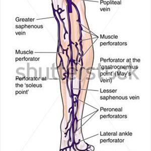 Spidervein Injections - Information On Varicose Veins