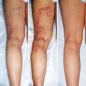 Ulcer Varicose - If Left Untreated, Varicose Veins Can Pose Risks