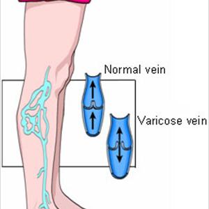 Sclerotherapy Varicose - Vein Misconceptions: The Truth Behind Varicose Veins