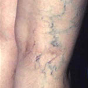 Prevent Varicose Viens - Sclerotherapy To Eliminate Spider And Varicose Veins