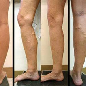 Evlt Varicose Veins - Top 7 Tips To Treat And Prevent Varicose Veins